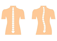 脊柱側彎的測量方法以及判定標準解讀